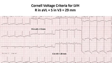 Can doctors tell me what does lvh by voltage criteria in an.